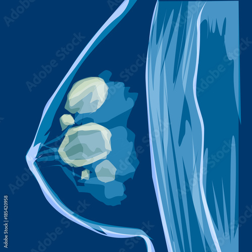 Breast cancer vector medicine illustration. Anatomy of woman disease