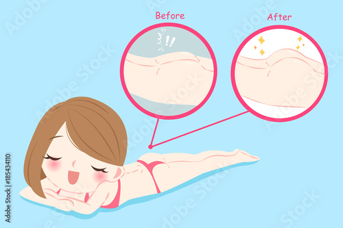 woman with butt implant