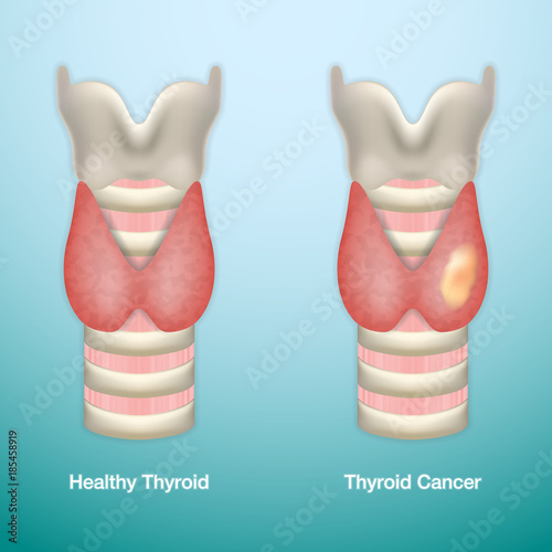 Healthy Thyroid and Thyroid Cancer. Vector Illustration.