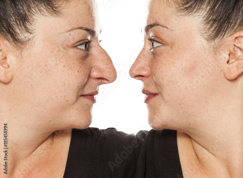 comparison of the female nose before and after correction