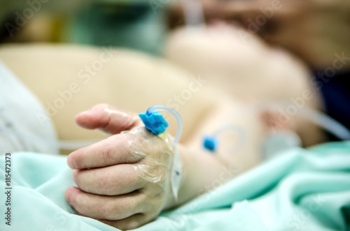 Peripheral catheter on a patient's hand before a cardiac operation.