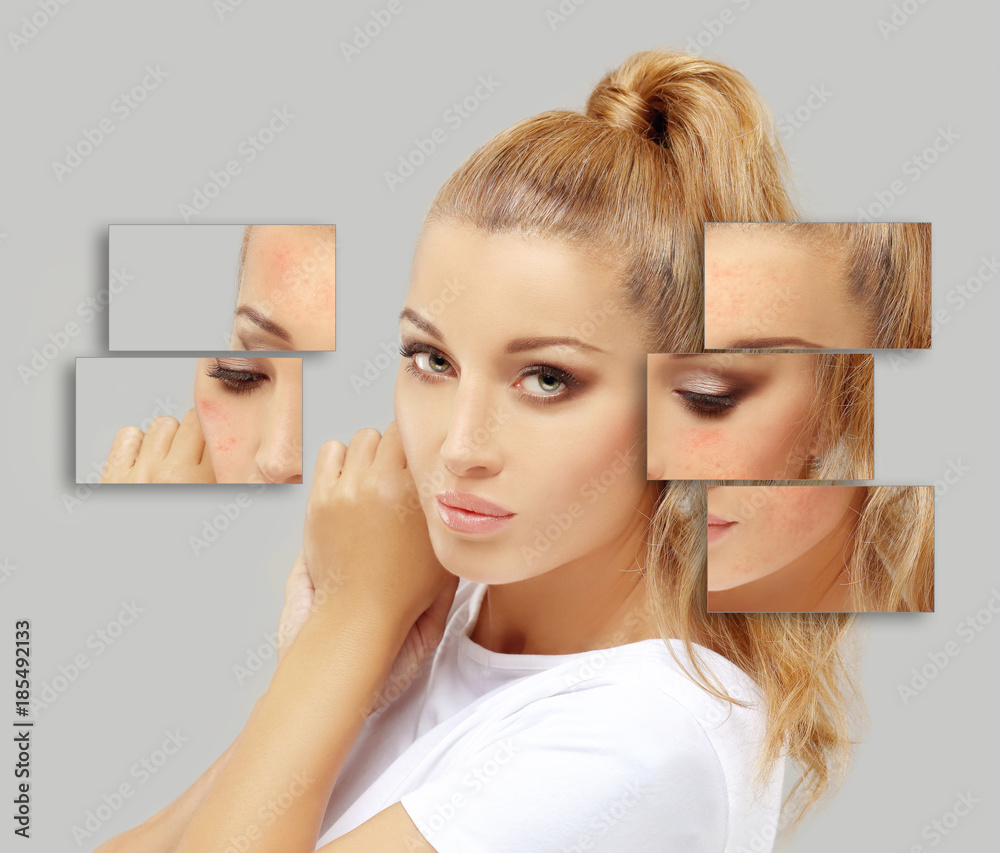 Naklejka premium Acne.Post-Acne Marks /Treating Acne Scars