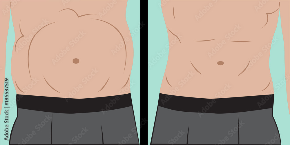 Abdominal bloating Abdominal bloating
