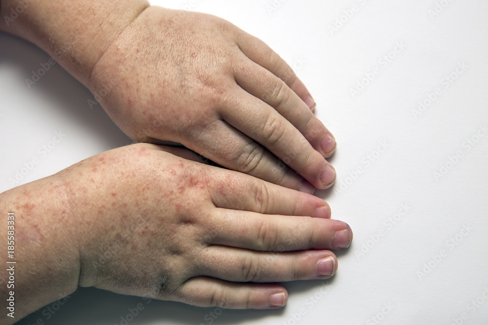 Scarlet fever. Two children's hands with rash on white background. Scarlet fever. Two children's hands with rash on white background.