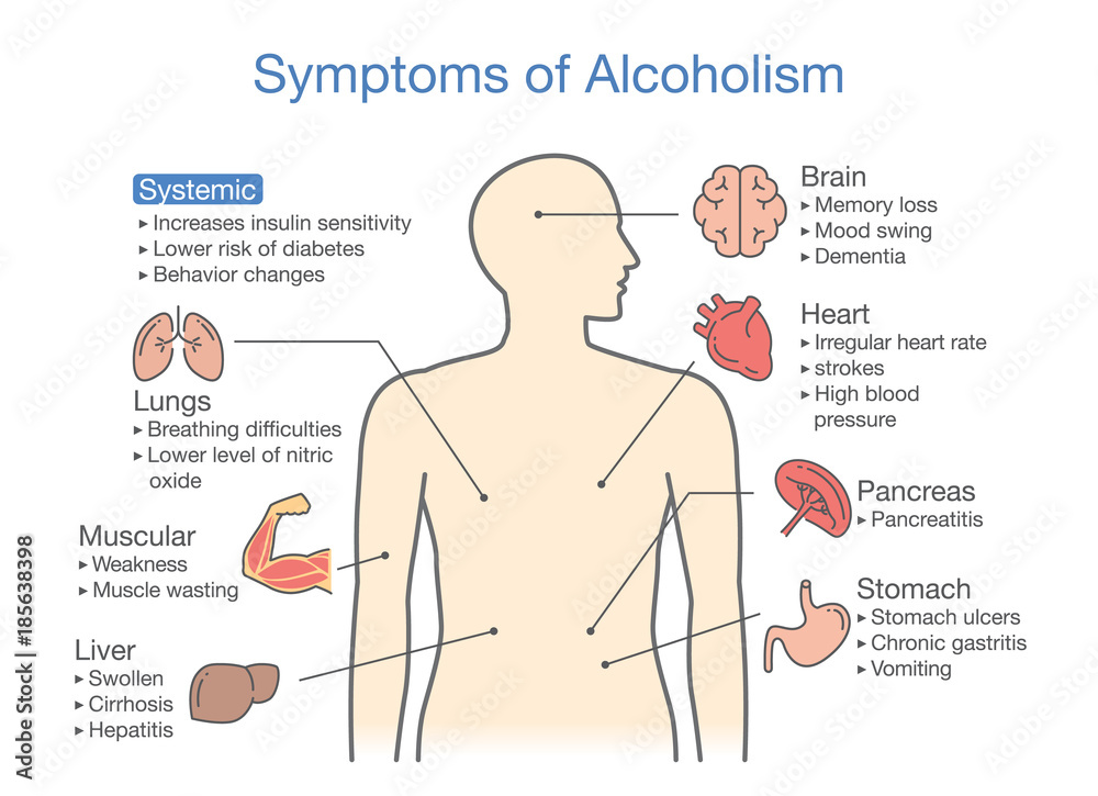 Symptom of alcoholism patient. Illustration about health problem of people with alcohol addiction. Stock Vector | Adobe Stock