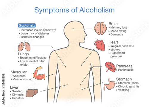 Symptom of alcoholism patient. Illustration about health problem of people with alcohol addiction.
