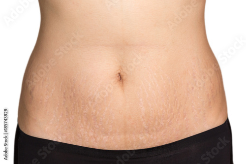 Woman belly fat pattern
