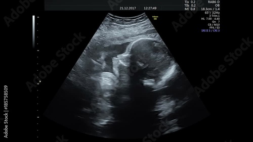 ultrasound of a pregnant woman with a baby photo