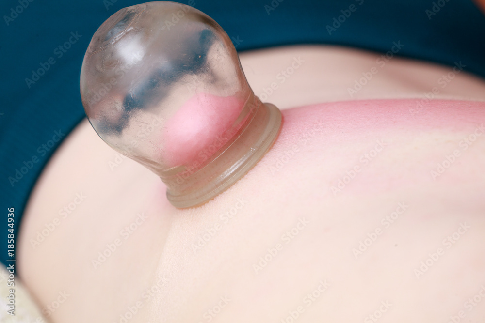 Fototapeta premium Alternative medicine. Fire cupping massage detail on woman's back