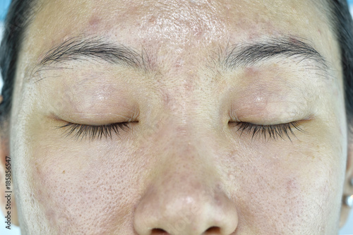 Facial skin problem, Aging problem in adult, wrinkle, acne scar, large pore, dark spot, dehydrate skin.