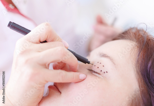 Surgeon correcting female face before the operation
