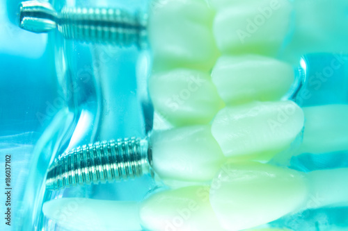 Vászonkép Dental titanium tooth implant