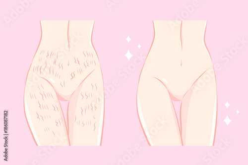 woman with stretch mark skin