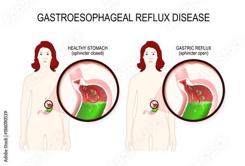 Gastroesophageal reflux disease. gerd