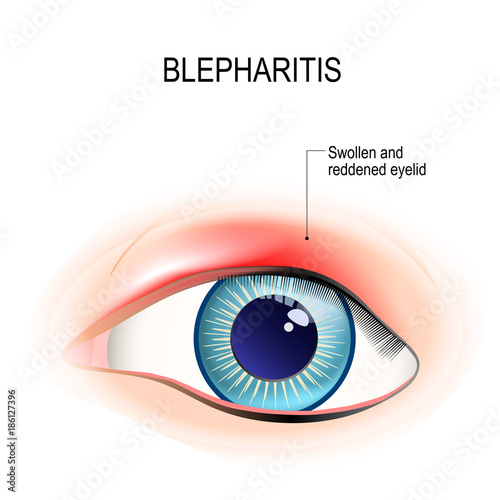 Eye of human. Blepharitis. inflammation of the eyelid