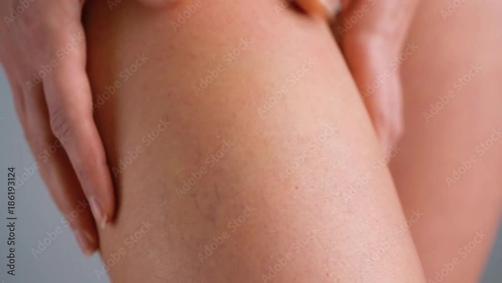 Female hip stretch marks and cellulite on the skin Female hip stretch marks and cellulite on the skin