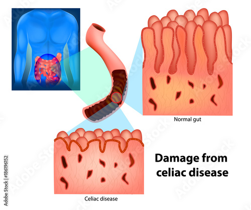 Damage from celiac disease. Celiac disease and Normal gut. Celiac disease affected small intestine villi.