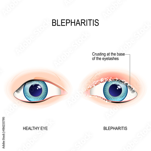 Eyes of human. Blepharitis. Crusting at the eyelid margins