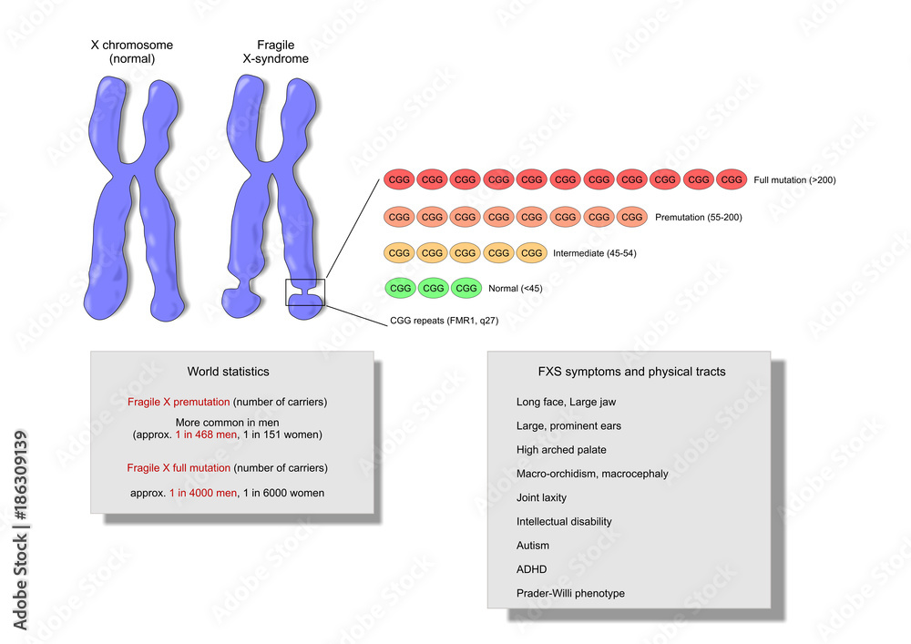 Fragile X syndrome, a genetic disorder of the X chromosome (FMR1 gene ...