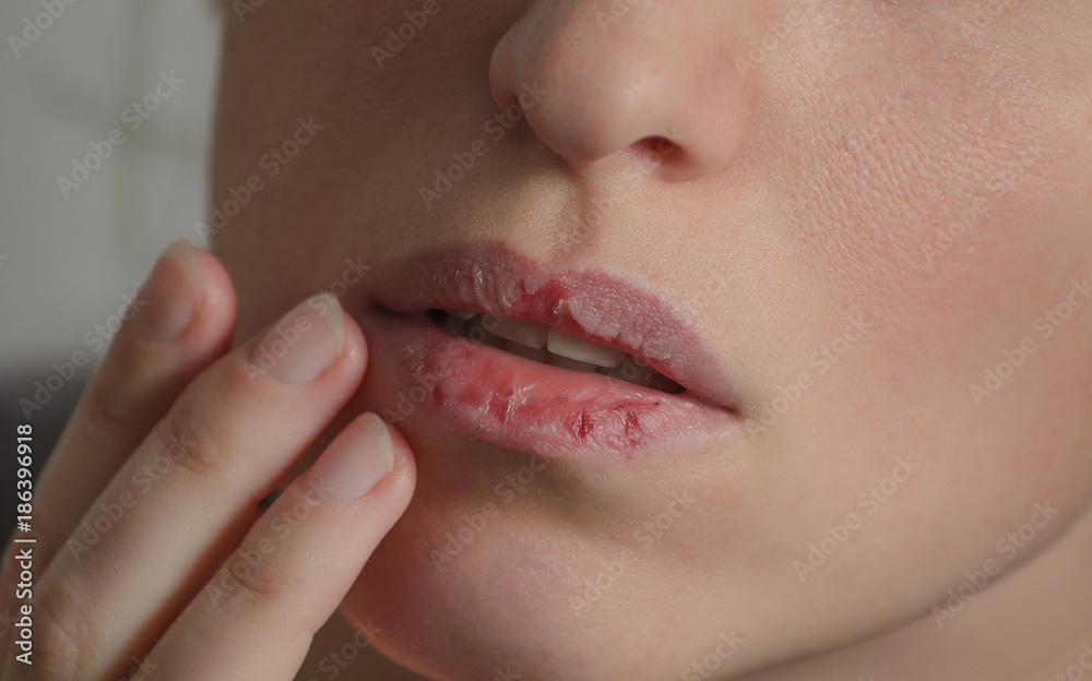 Dermatillomania skin picking. Woman has bad habit to picks her lips. Harmful addiction based on anxiety stress and dry lips. Excoriation disorder. Sick cracked damaged tissue.