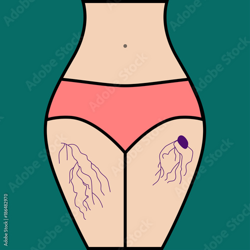 Varicose veins