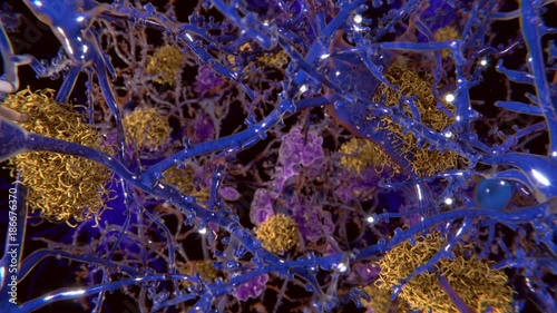 Alzheimers in the brain, animation photo