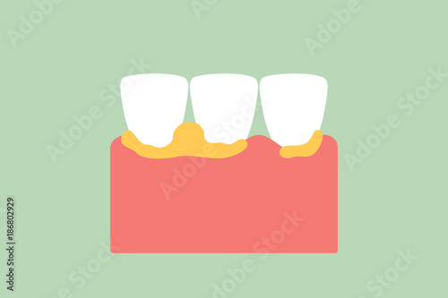 dental plaque cause to periodontal disease