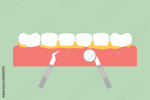 teeth scaling, dental plaque removal for cleaning