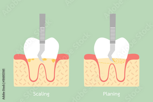 teeth scaling - dental plaque removal, anatomy structure including the bone and gum