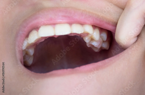 Crowding teeth. malocclusion teeth. In the mouth of this child with permanent teeth up insert the milk teeth that have not dropped.