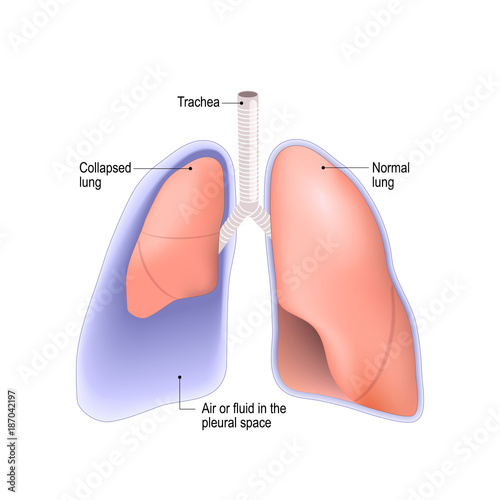 Collapsed lung. pneumothorax, or pleural effusion, or empyema photo