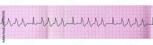 Canvas Print Tape ECG with group ventricular extrasystoles