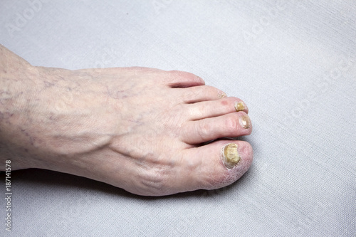 fungus on toe nails photo