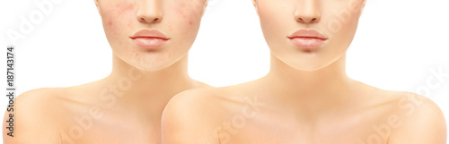 Post-Acne Marks /Treating Acne Scars