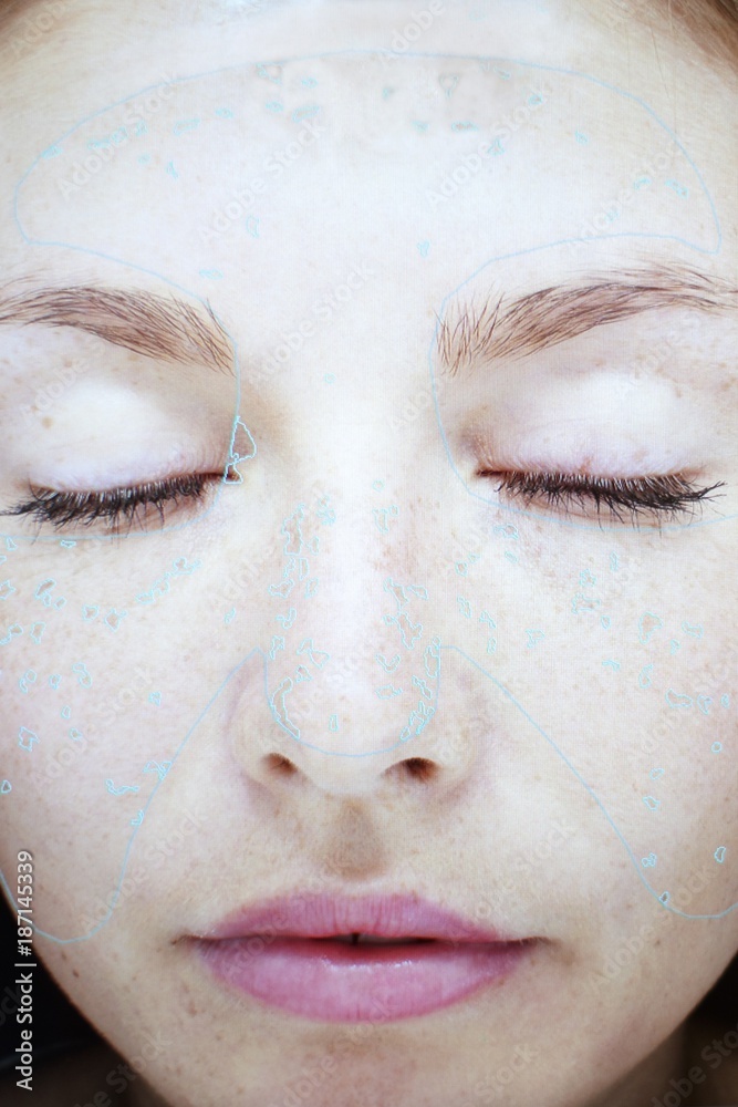 Image of young woman's face in skin clinic Image of young woman's face in skin clinic