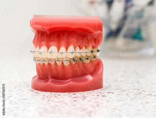 Dentist demonstration teeth model of orthodontic bracket