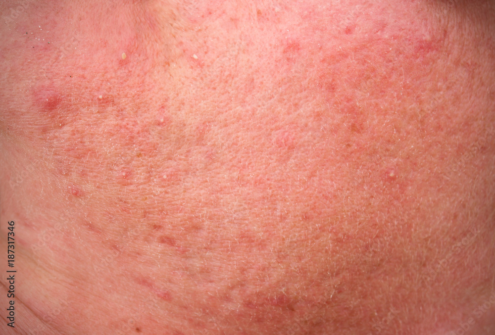 rosacea skin disease on the face