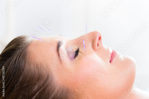 Woman at acupuncture with needles in face receiving alternative treatment