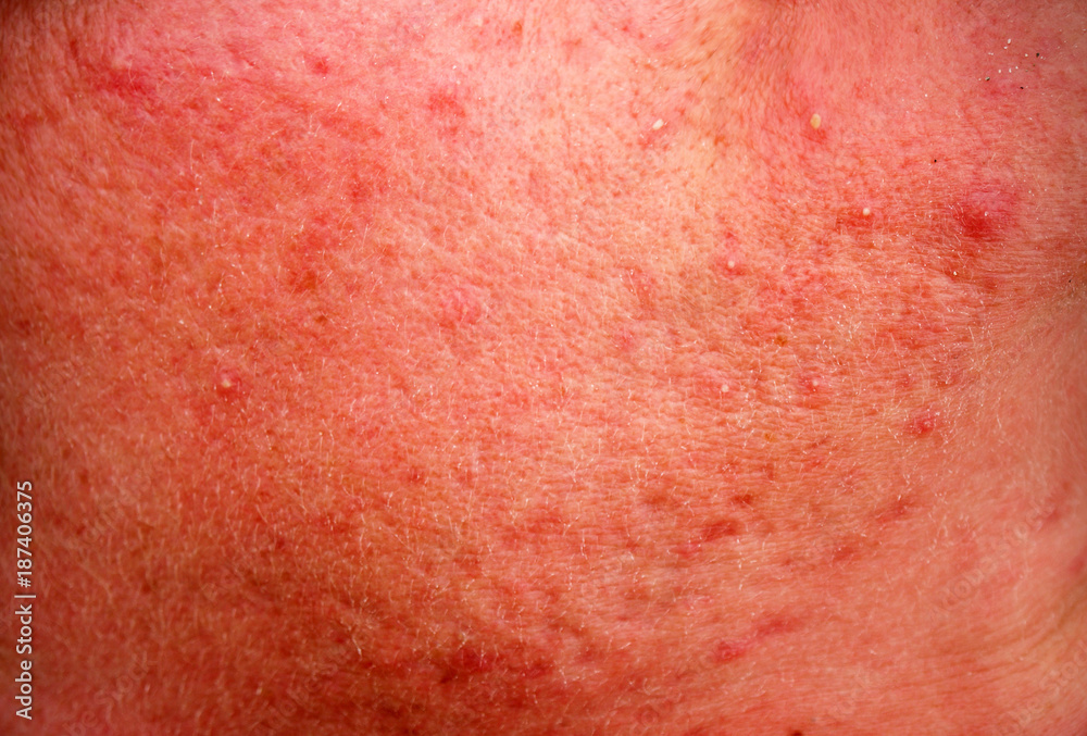 Fototapeta premium rosacea skin disease on the face