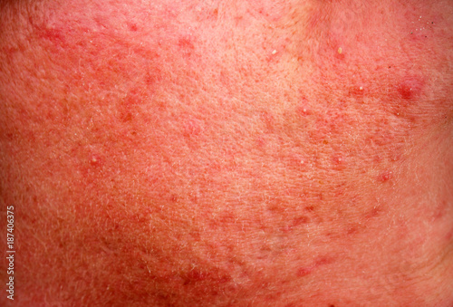 rosacea skin disease on the face photo