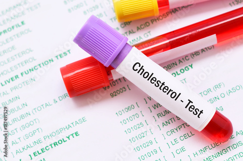 Test tube with blood sample for cholesterol test