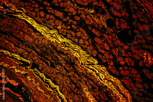 Muscular atrophy of human skeletal muscle
