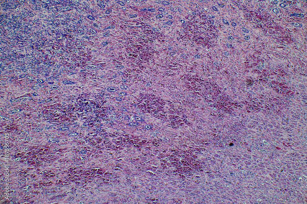 human kidney tissue infarction