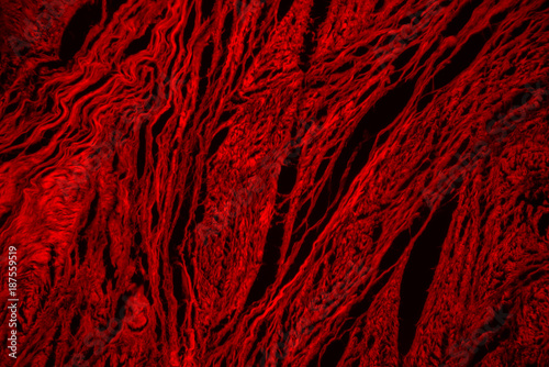 Connective tissue hyaline degeneration of human photo