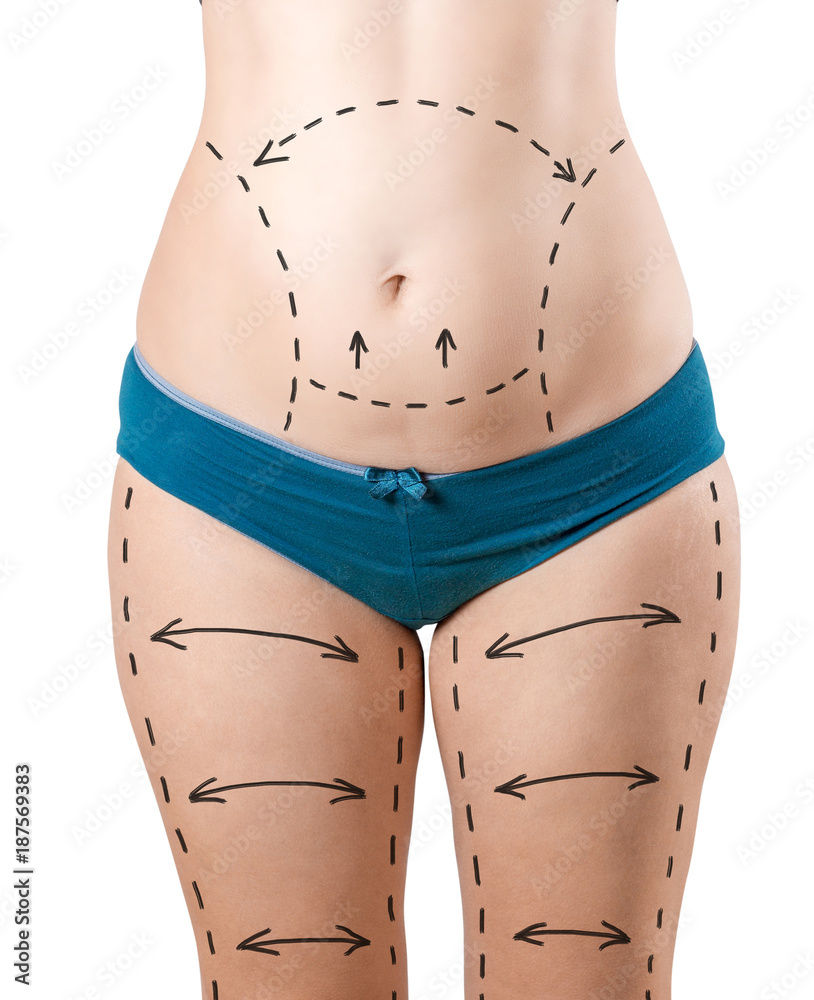 Plastic surgery of the female body. Liposuction of the hips, legs, tummy  tuck, waist. Drawing arrows and lines with perforation for preparation for  surgery. Fat woman in underwear isolated Photos