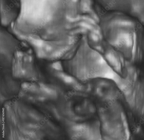 3D Ultrasonography Analysis of a 4th Month Fetus
