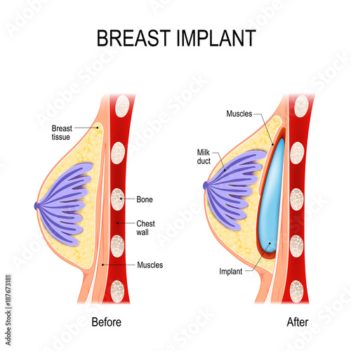 Breast Implant. Cosmetic (plastic) surgery