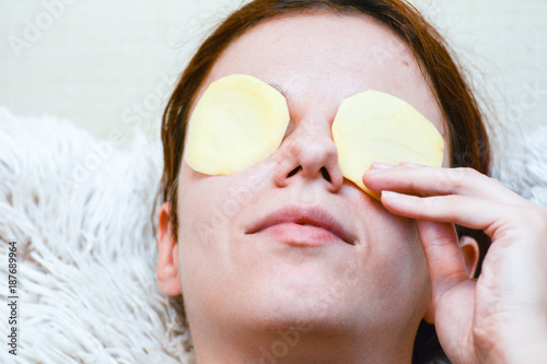 Redhead model using slices of potato to relieve her dark circles and puffy eyes