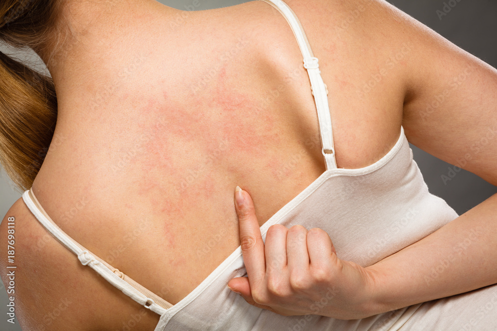 woman scratching her itchy back with allergy rash Stock Photo