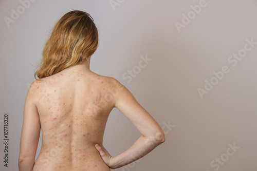 Young girl with acne, with red spots on the back